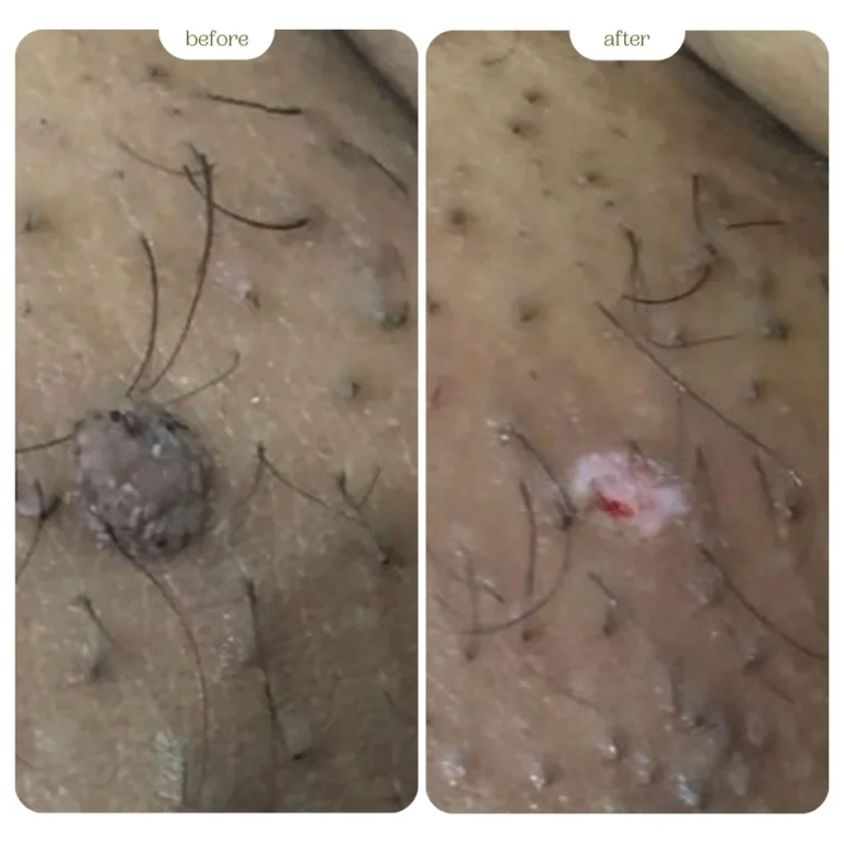 Genital warts Before & After