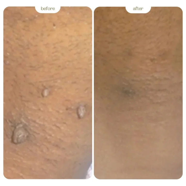 Genital warts Before & After