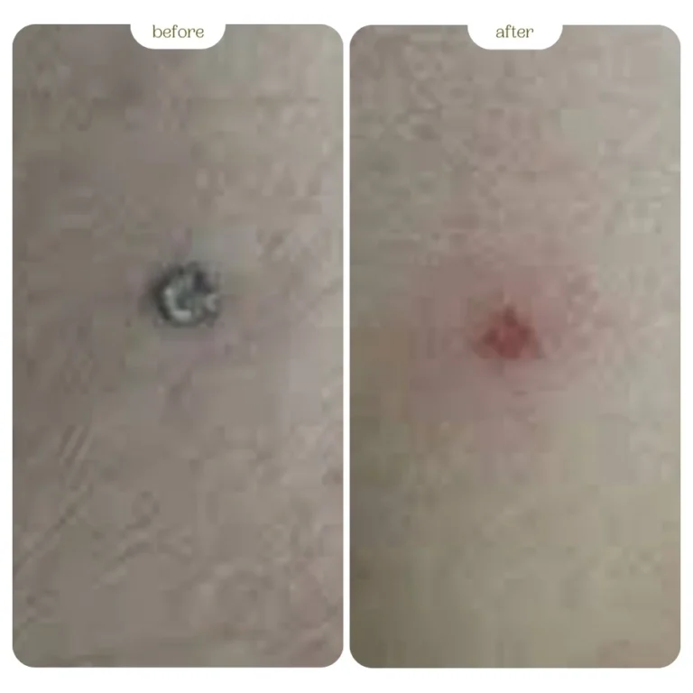 Genital warts Before & After