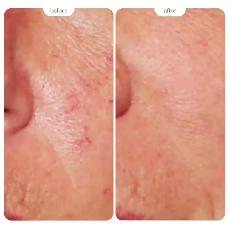 Thread Veins Before and After