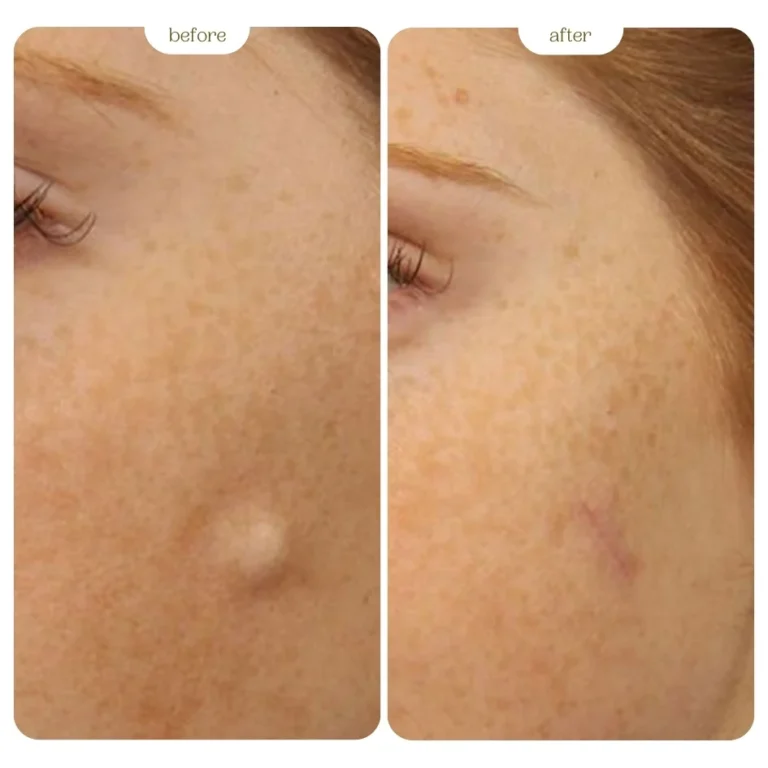 cyst before and after