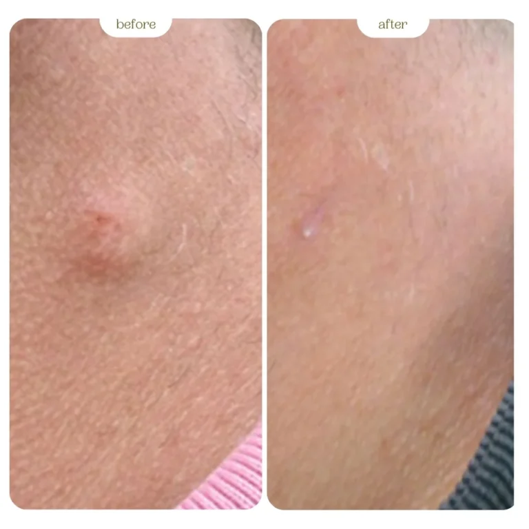 Lipoma before and after