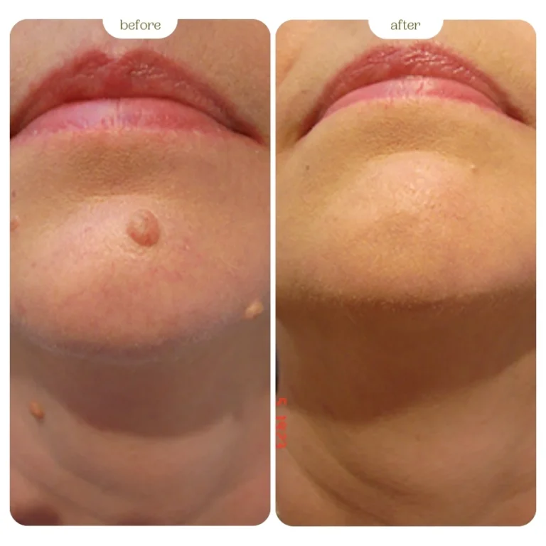 Mole Before & After