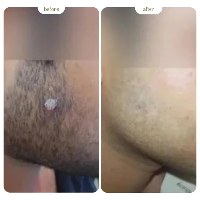 Warts Before and After