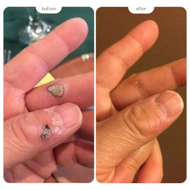 Warts Before and After