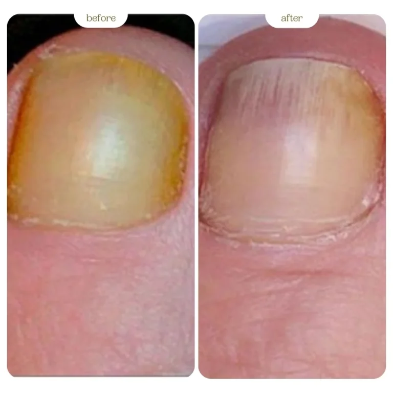 Nail Fungus Before & After