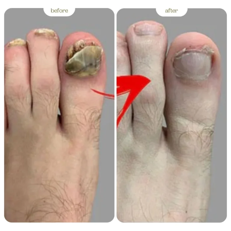 Nail Fungus Before & After