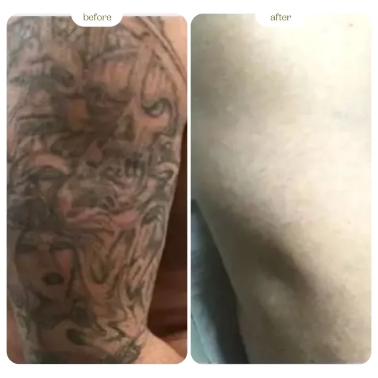 Tattoo Before & After