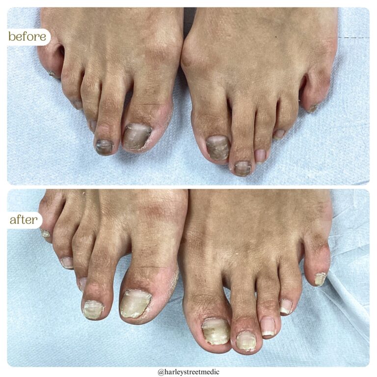 Nail Fungus Before & After