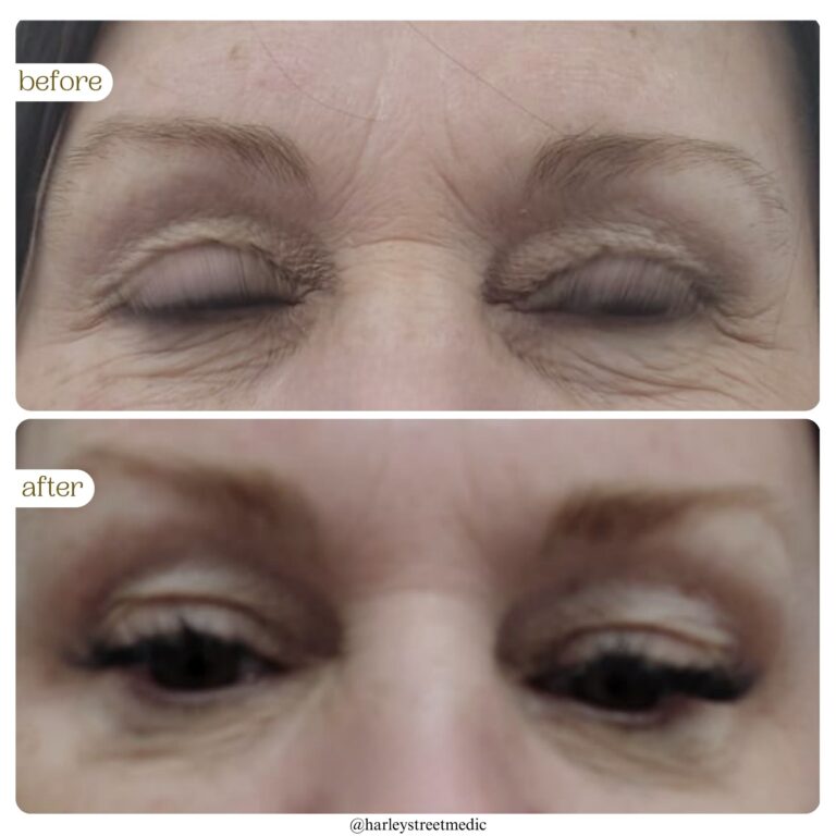Dark Circles Before and After