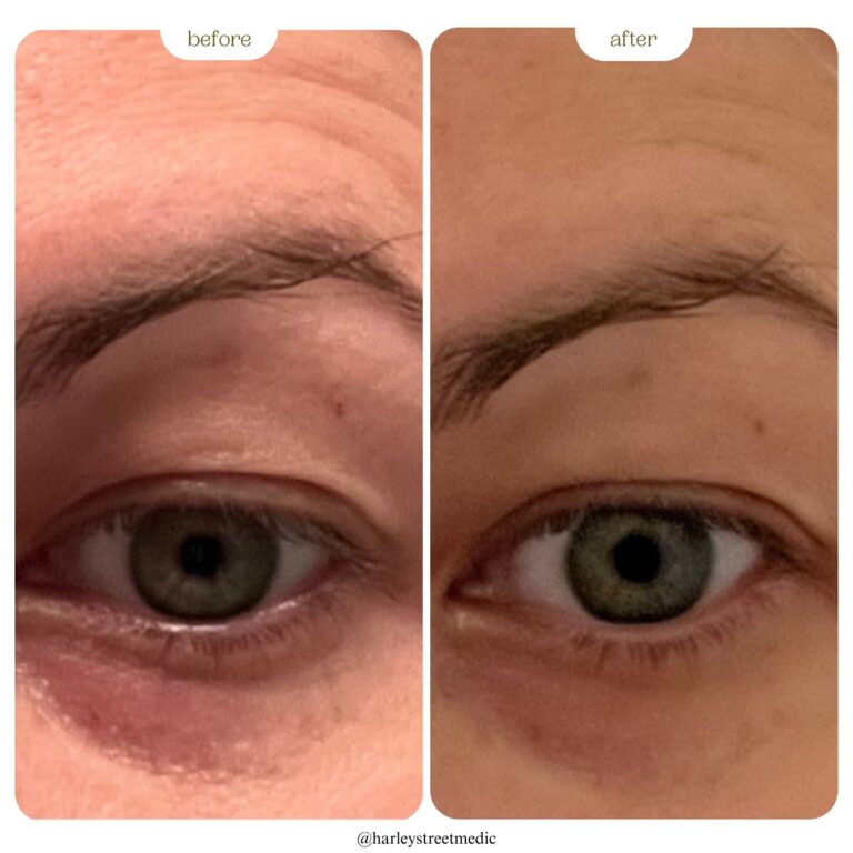 Dark Circles Before and After