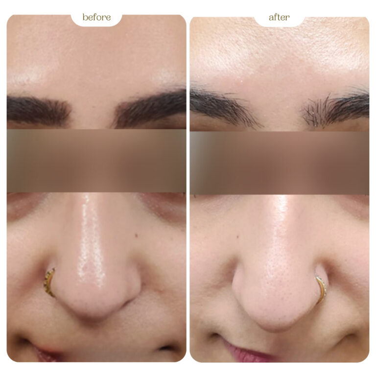 Dark Circles Before and After