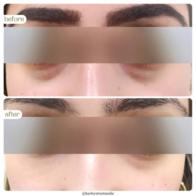 Dark Circles Before and After