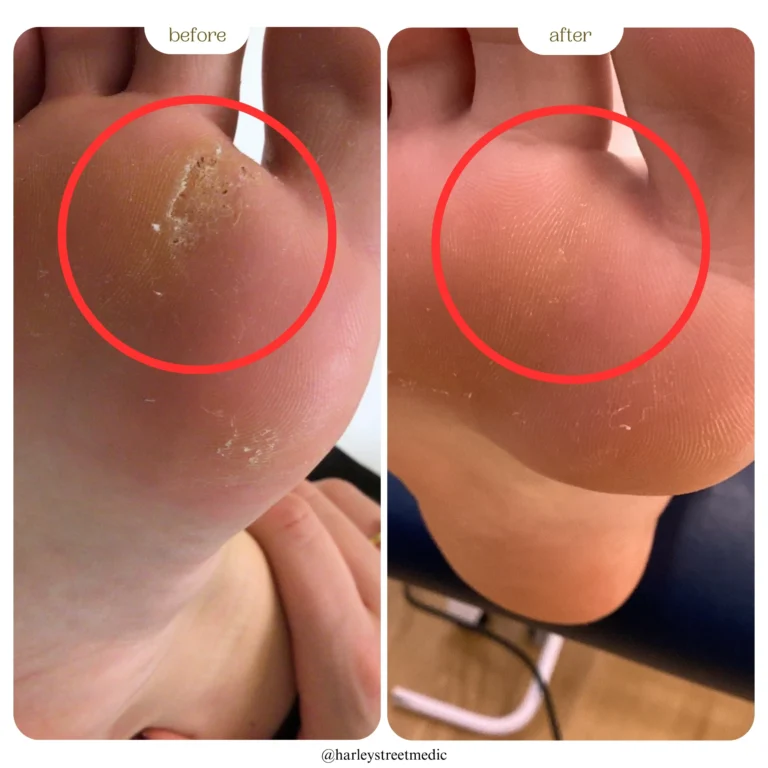 verruca before and after