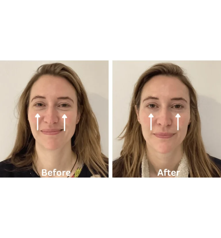 Dark Circles Before and After