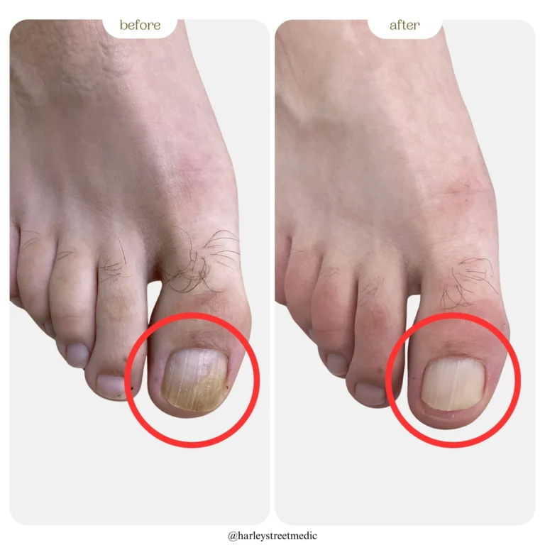 Nail Fungus Before & After