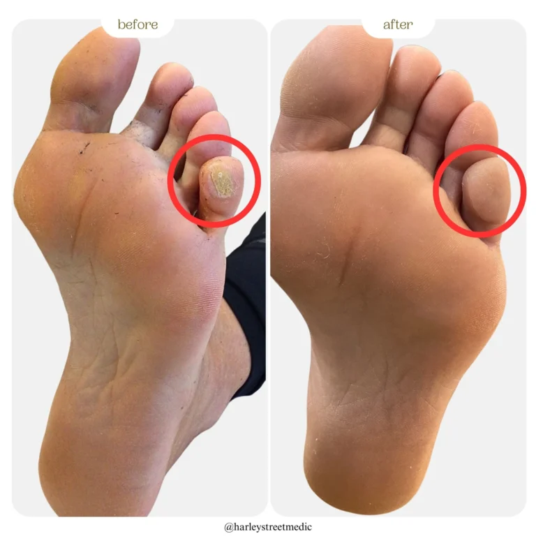 verruca before and after