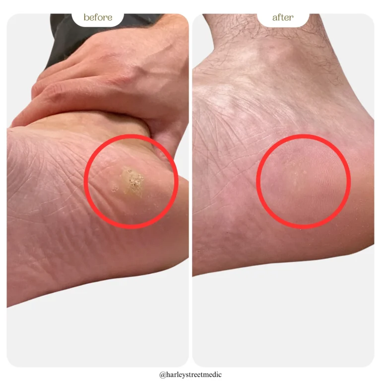 verruca before and after