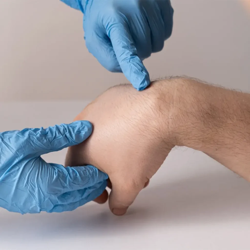 Lipoma