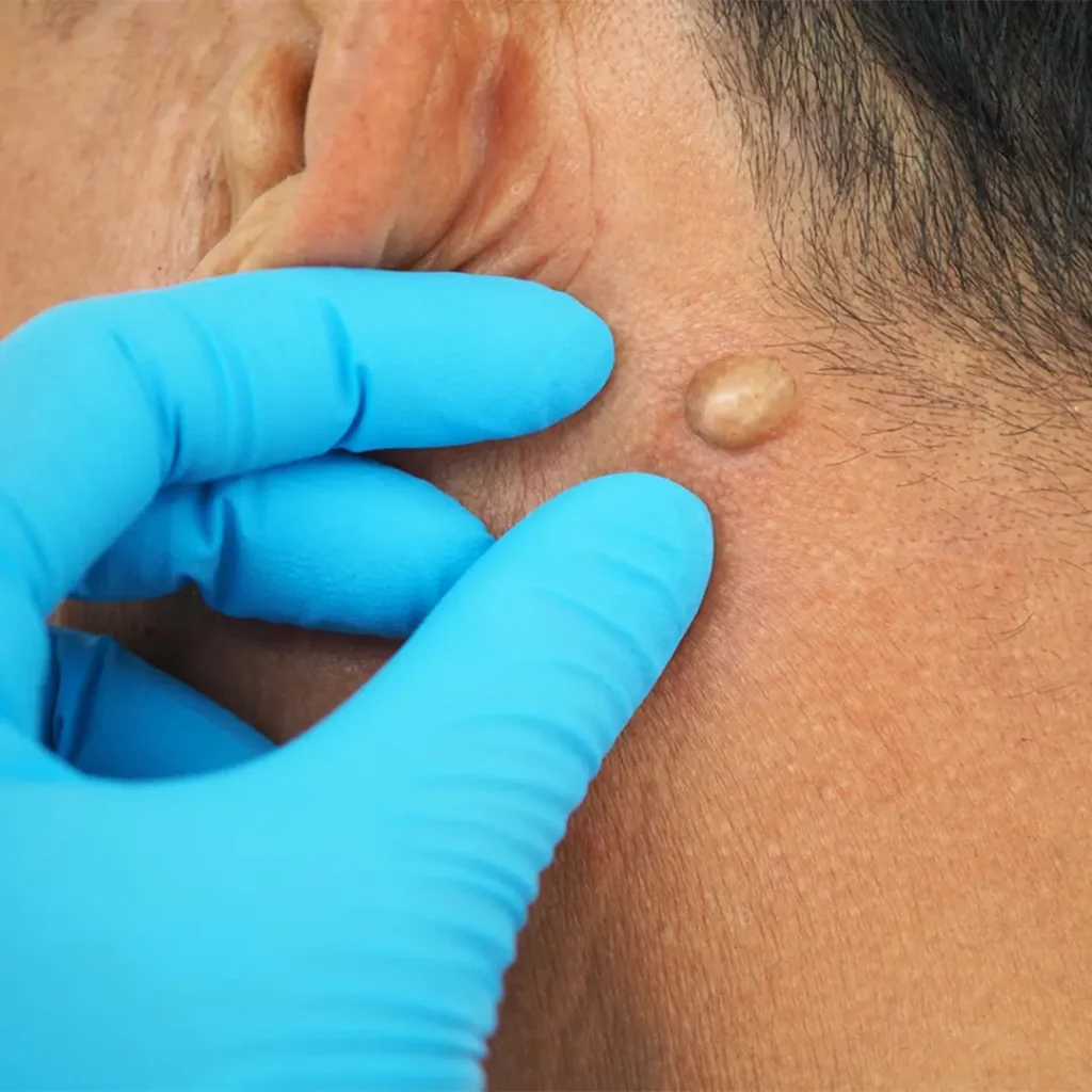 Cysts