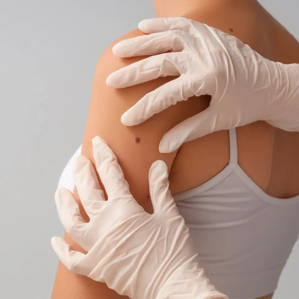 Moles