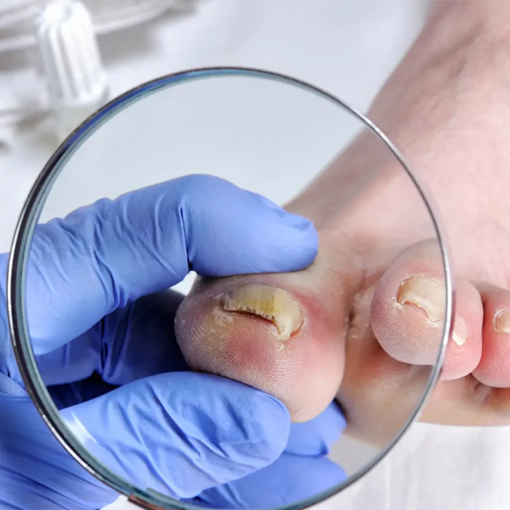 Nail Fungus