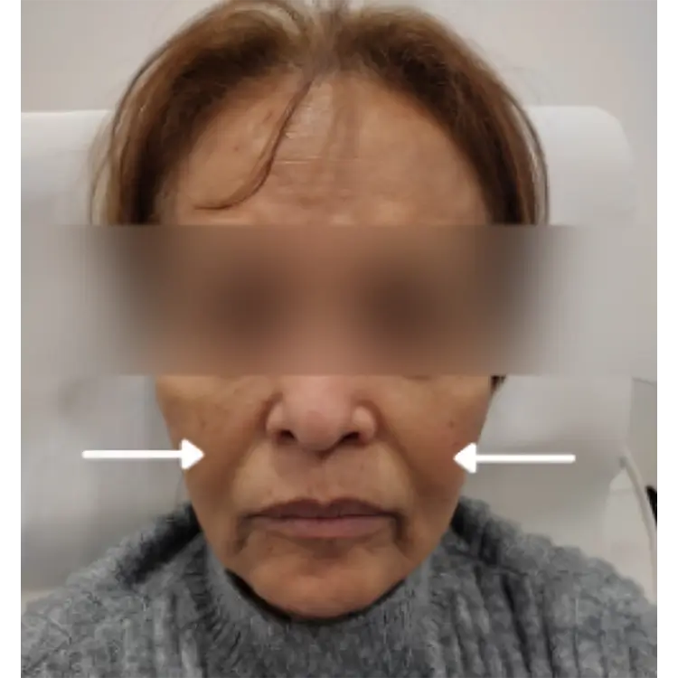 After Nasolabial Fold treatment