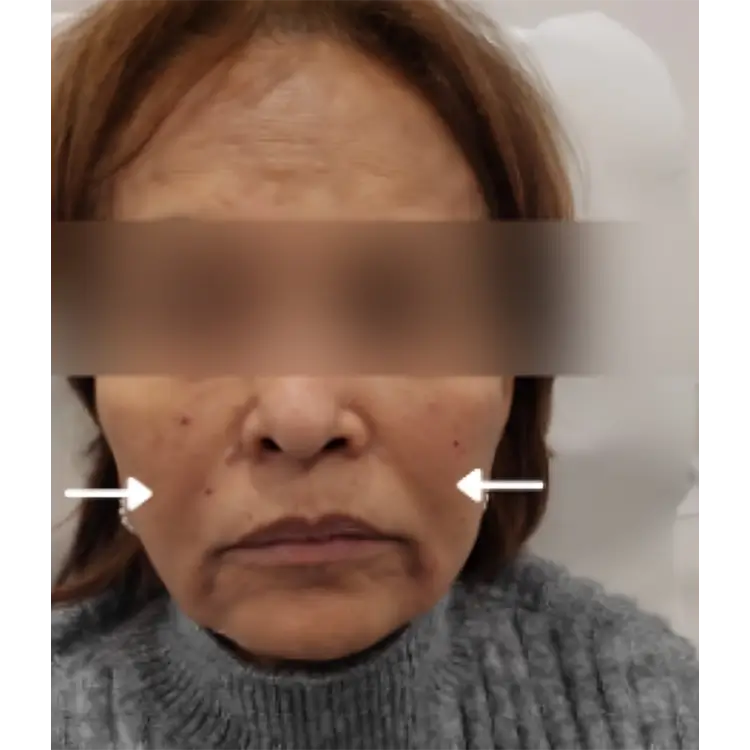 Before Nasolabial Fold treatment