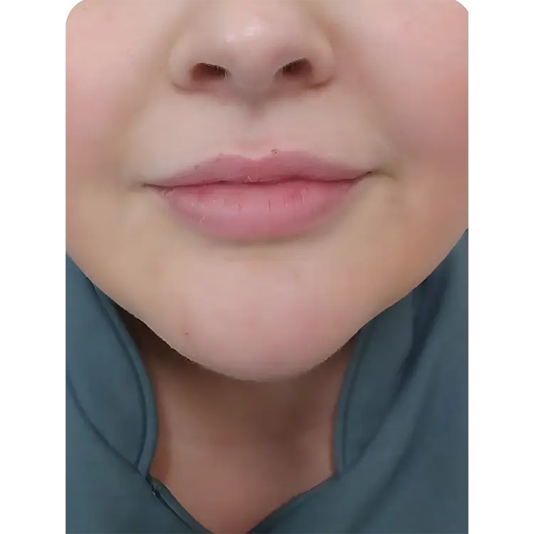 After Lip Filler treatment