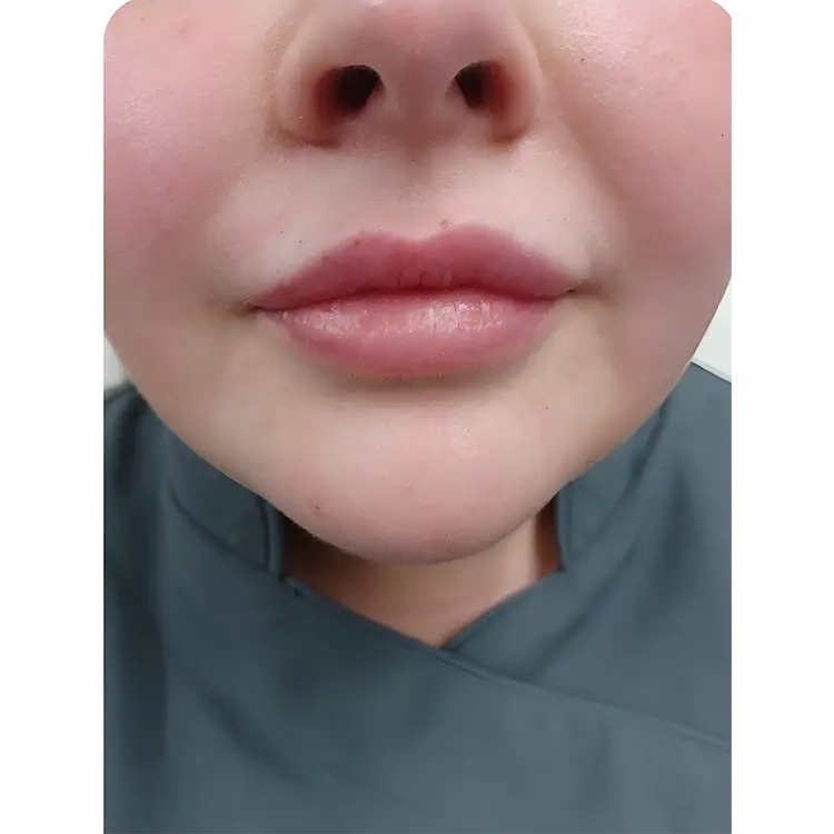 Before Lip Filler treatment
