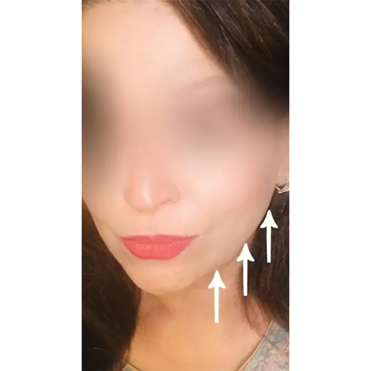 Before jawline treatment