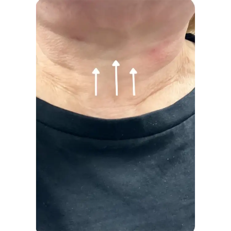 Before Neck Lift treatment