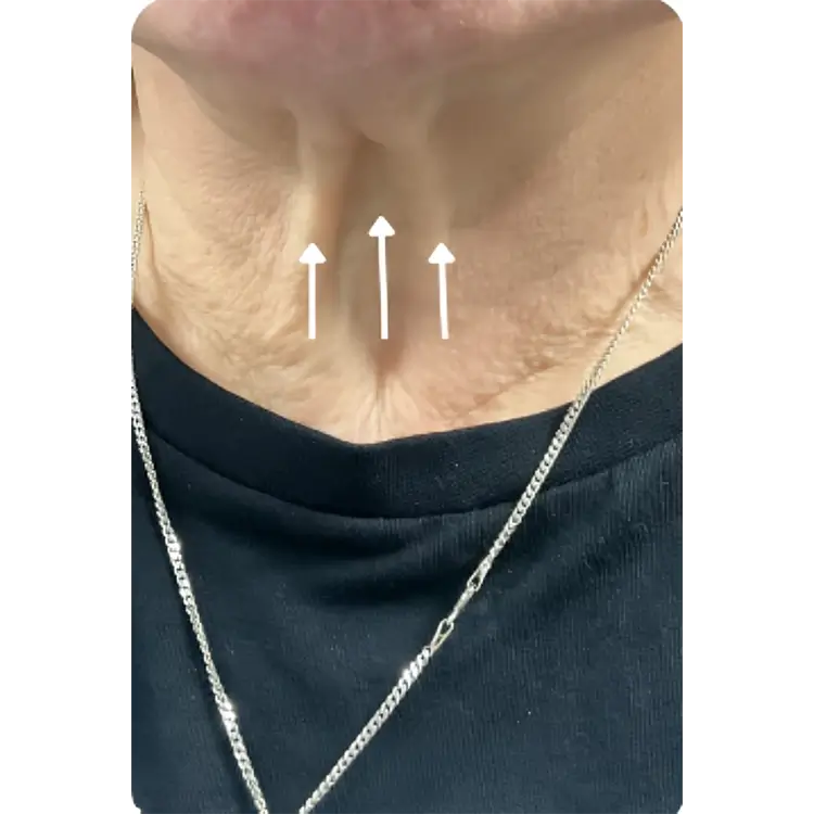 After Neck Lift treatment